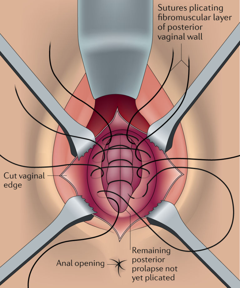 Perineorrhaphy surgery