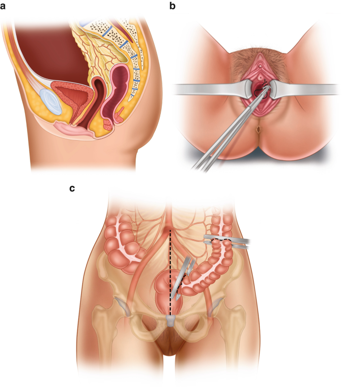 Vaginoplasty surgery