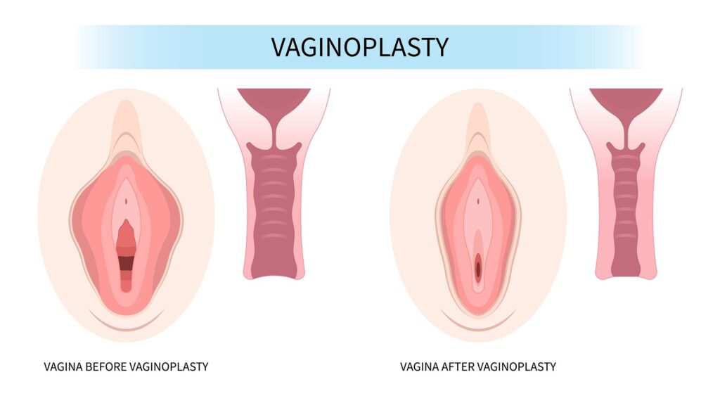 Vaginal rejuvenation