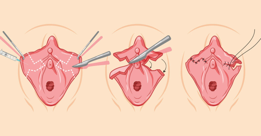 Labiaplasty operation