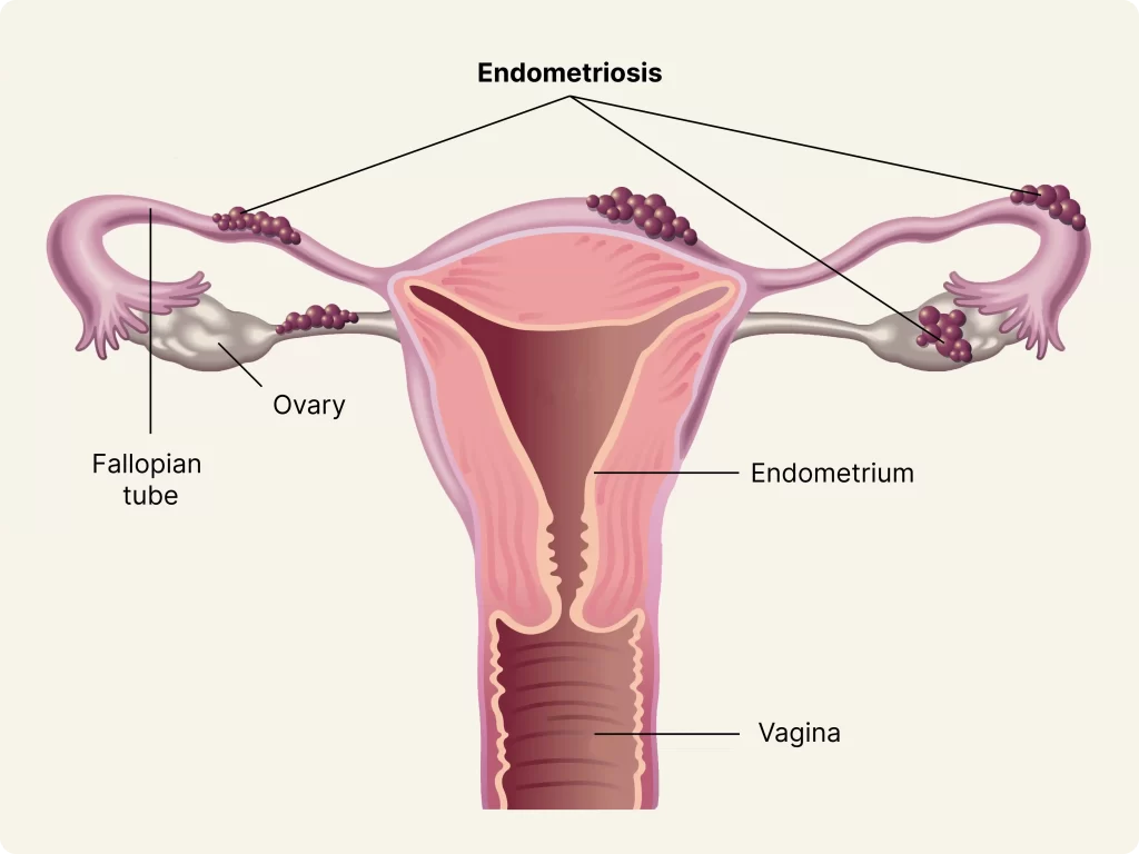 Endometriosis