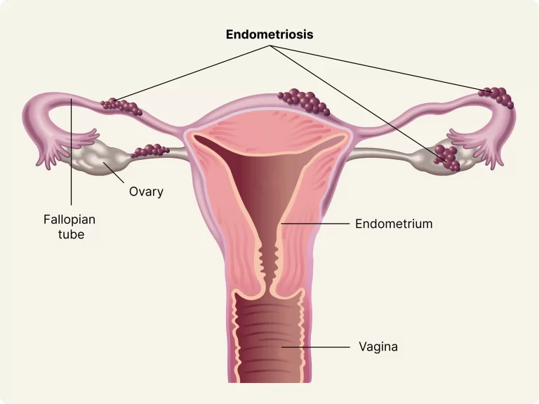 Endometriosis