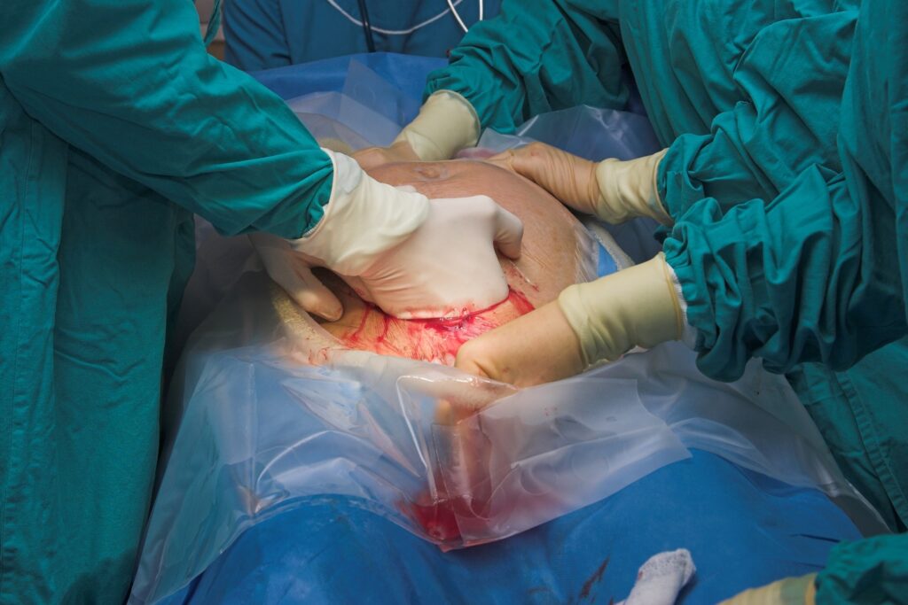 Cesarean delivery