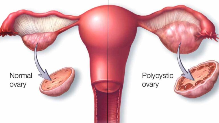 Polycystic ovary syndrome