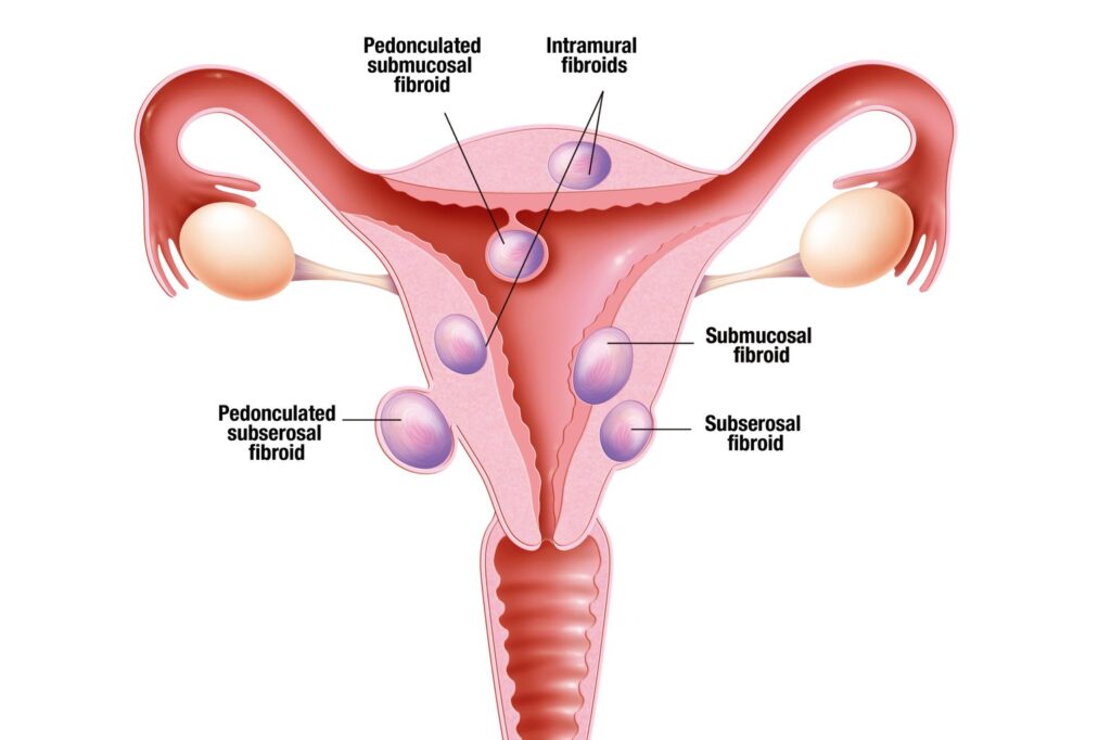 Uterine fibroids