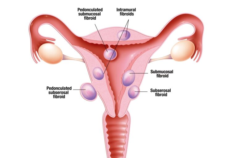 Uterine fibroids