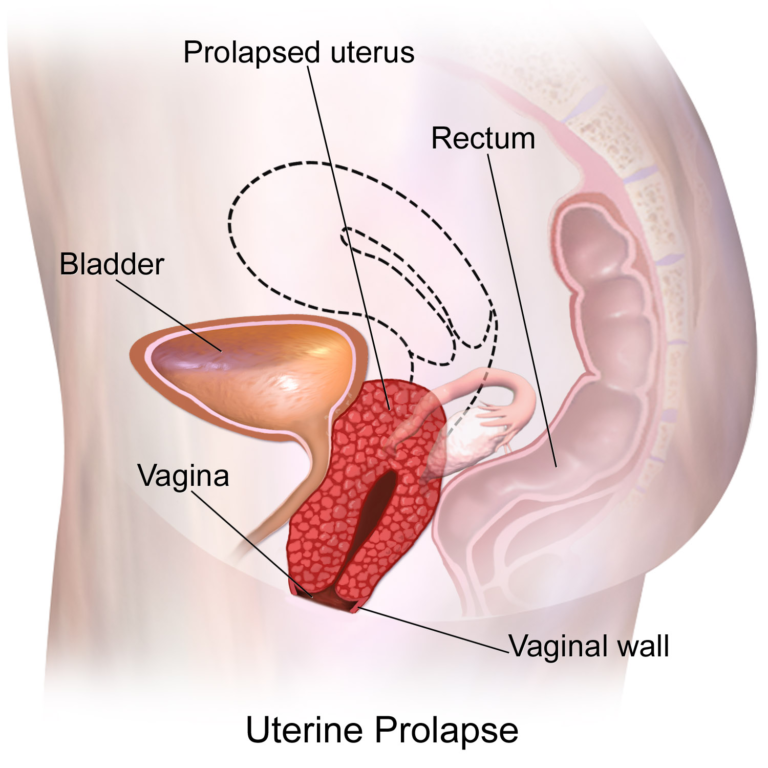Uterine and bladder prolapse
